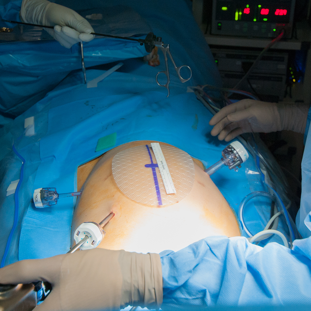 Hernia surgery